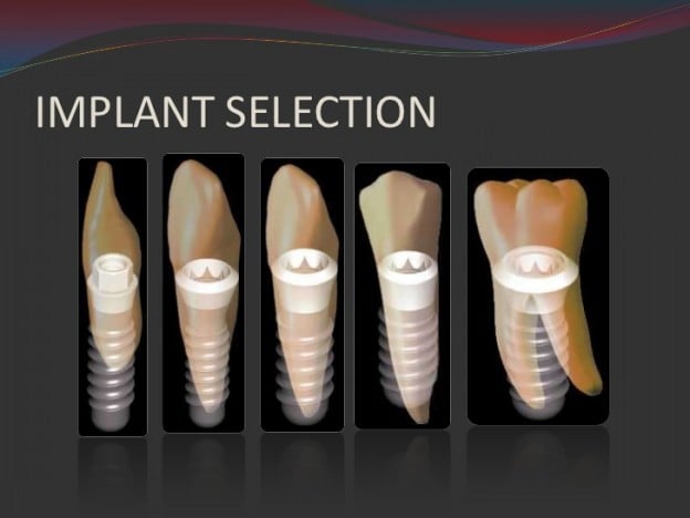 İmplant tedavisi ve implant seçimi