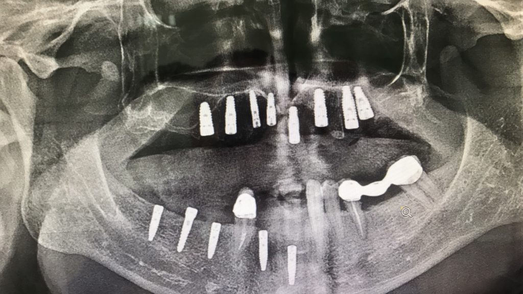 Panoramik diş röntgeni örneğinde implant