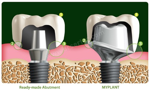 Kişiye özel Bego implant