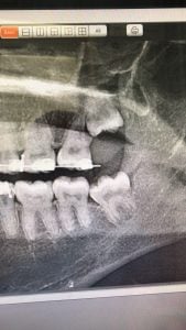 Kanal tedavisi ve yirmilik diş için panoramik röntgen